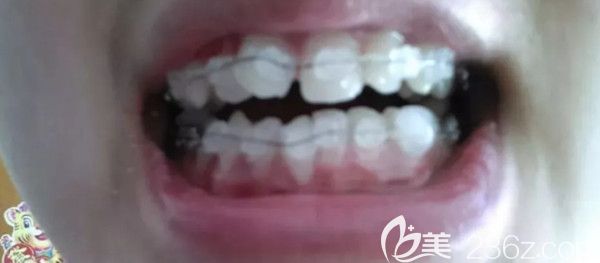 戴上陶瓷半隱形托槽第1天 戴上陶瓷半隱形托槽第1天