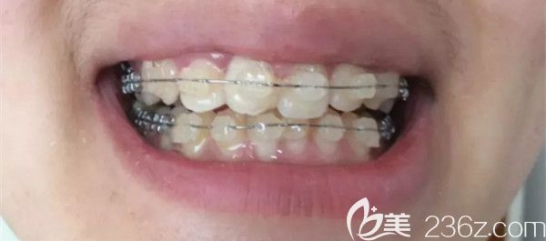 半隱形托槽第100天變化圖 半隱形托槽第100天變化圖