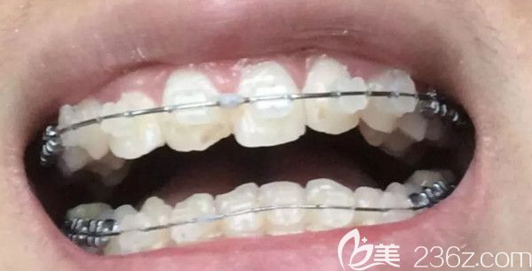 牙齒矯正第5個(gè)月效果圖 牙齒矯正第5個(gè)月效果圖