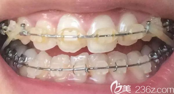 戴牙套第2年牙齒的照片 戴牙套第2年牙齒的照片
