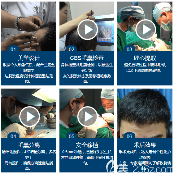 廣州荔醫(yī)植發(fā)陸昌龍醫(yī)生植發(fā)過程圖 廣州荔醫(yī)植發(fā)陸昌龍醫(yī)生植發(fā)過程圖