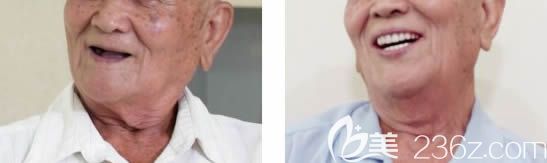 湛江致美口腔周東風(fēng)院長(zhǎng)解答高齡老人能種牙嗎 湛江致美口腔周東風(fēng)院長(zhǎng)解答高齡老人能種牙嗎