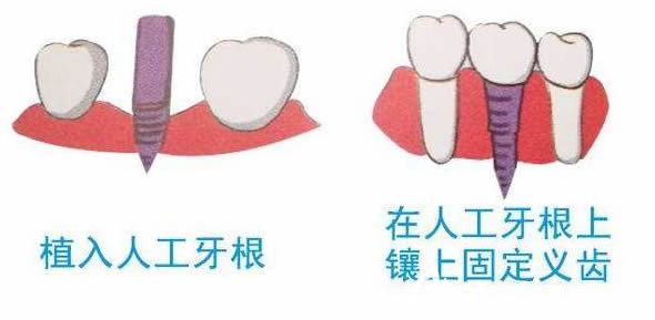 湛江致美口腔曾玉珠醫(yī)生解答關(guān)于種植牙的相關(guān)知識(shí)