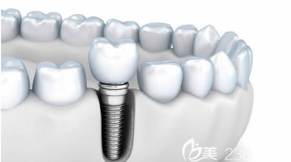 種植牙價(jià)格需要多少錢一顆