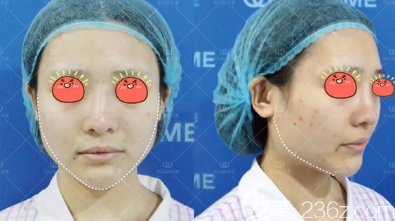 術前嫩牛五方臉的照片 術前嫩牛五方臉的照片