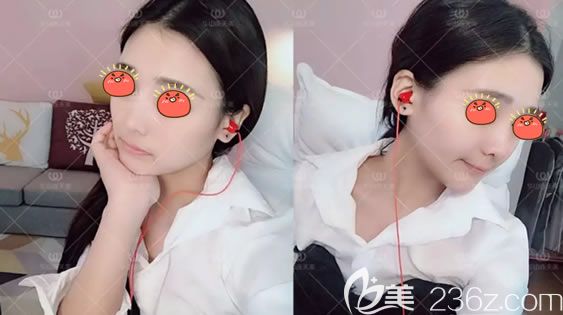 杭州高俊明長曲線下頜角手術案例 杭州高俊明長曲線下頜角手術案例