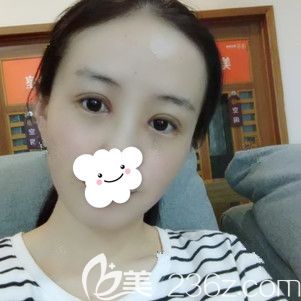 一周拆線后眼部腫脹基本消退