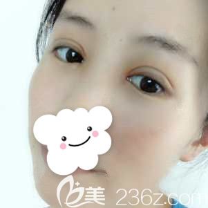 十天眼綜合恢復(fù)情況