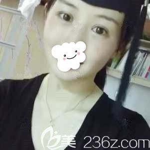 征募上徐州時光洪揚的模特后挑戰(zhàn)了以全切雙眼皮為主的眼綜合加上自體脂肪面部填充 還拿到價格參考表