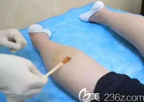 注射瘦腿的消毒過程 注射瘦腿的消毒過程