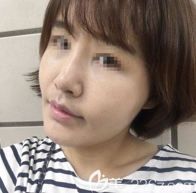 在韓國芭堂做面部埋線提升+自體脂肪填充術(shù)后9天