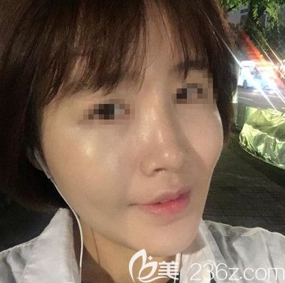 在韓國芭堂做面部埋線提升+自體脂肪填充術(shù)后2周