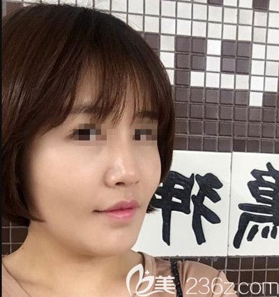 在韓國芭堂做面部埋線提升+自體脂肪填充術(shù)后1個月