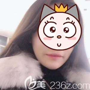 楊主任做玻尿酸墊下巴術(shù)后35天下巴恢復(fù)自然