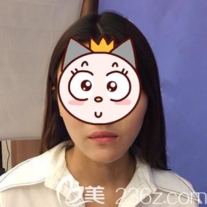 楊主任幫我注射玻尿酸墊下巴術(shù)后即刻效果