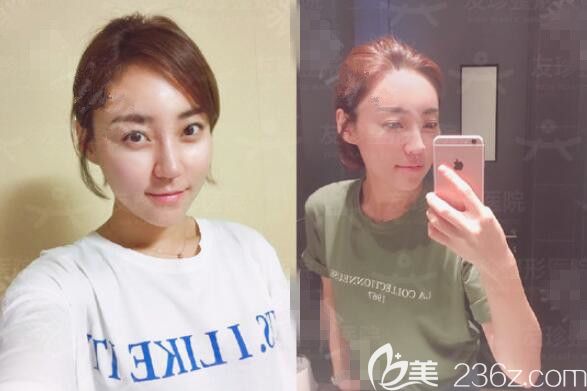 30+干癟老阿姨在韓國友珍姜泰兆做了3D面部脂肪填充和prp后感覺變成可愛小姐姐