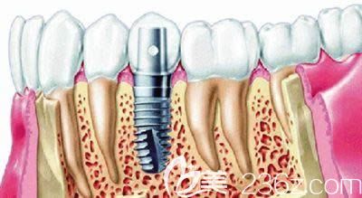 牙齒種植是否會發(fā)生并發(fā)癥呢
