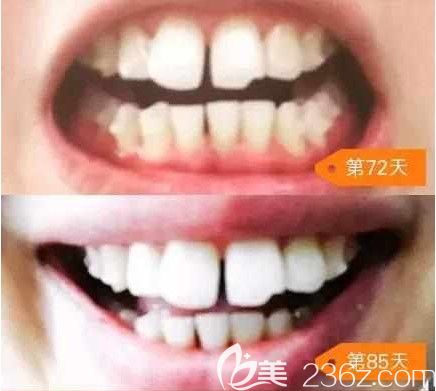 剛帶隱適美牙套72天和第85天的照片