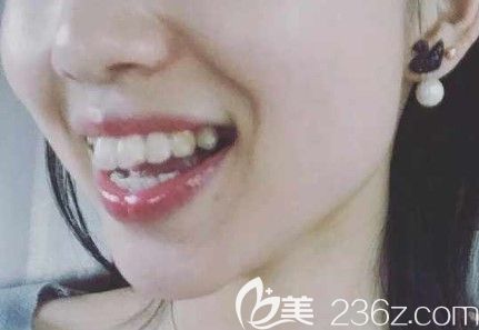 戴第12副牙套的留照