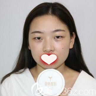 在長沙亞韓做眼綜合術(shù)前照 在長沙亞韓做眼綜合術(shù)前照