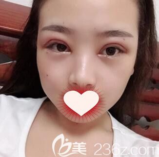 韓式切開雙眼皮+開眼角術(shù)后2天照 韓式切開雙眼皮+開眼角術(shù)后2天照