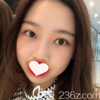 在長沙做雙眼皮+開眼角術(shù)后20天效果 在長沙做雙眼皮+開眼角術(shù)后20天效果