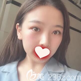 在長沙亞韓做雙眼皮+開眼角術(shù)后30天效果 在長沙亞韓做雙眼皮+開眼角術(shù)后30天效果