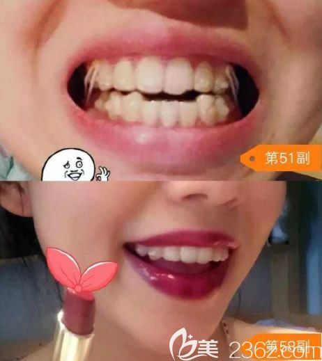 第51和58副牙套正在進(jìn)行微調(diào)