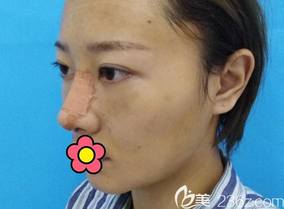 蘭州仁和鼻綜合隆鼻第三天圖片 蘭州仁和鼻綜合隆鼻第三天圖片