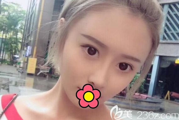 硅膠假體隆鼻+自體耳軟骨隆鼻一個月恢復圖 硅膠假體隆鼻+自體耳軟骨隆鼻一個月恢復圖