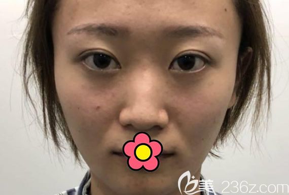 蘭州仁和醫(yī)院整形科<!--<i data=20240703-sp></i>-->鼻綜合隆鼻前 蘭州仁和醫(yī)院整形科<!--<i data=20240703-sp></i>-->鼻綜合隆鼻前