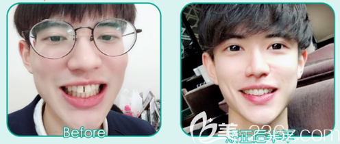 廣州藝美袁媛主任半透明陶瓷托槽牙齒矯正案例 廣州藝美袁媛主任半透明陶瓷托槽牙齒矯正案例