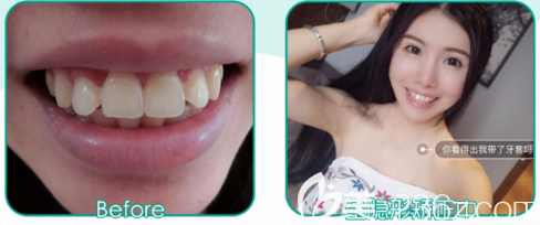 廣州藝袁媛做的全透明隱形牙齒矯正案例對比圖 廣州藝袁媛做的全透明隱形牙齒矯正案例對比圖