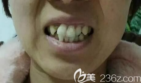 我在武漢德韓口腔做牙齒矯正前的照片 我在武漢德韓口腔做牙齒矯正前的照片
