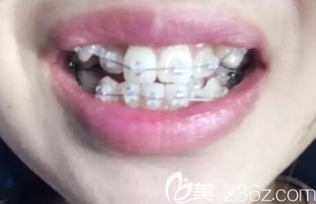 我在武漢德韓口腔做牙齒矯正第4個(gè)月 我在武漢德韓口腔做牙齒矯正第4個(gè)月