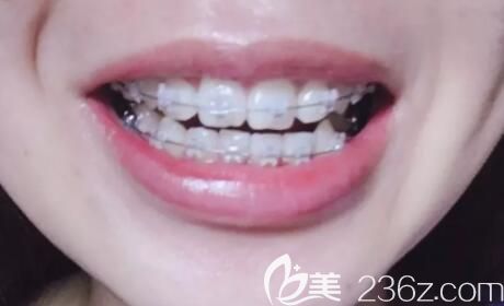 我在武漢德韓口腔做陶瓷托槽牙齒矯正第9個(gè)月 我在武漢德韓口腔做陶瓷托槽牙齒矯正第9個(gè)月