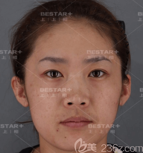 在北京上上相做自體脂肪面部填充前正面樣子 在北京上上相做自體脂肪面部填充前正面樣子