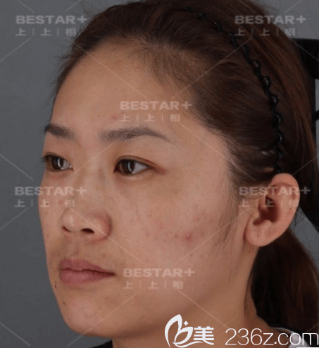 在北京上上相做自體脂肪面部填充前45度照 在北京上上相做自體脂肪面部填充前45度照