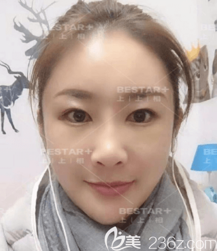 鄭楚蓉醫(yī)生給我做自體脂肪面部填充第15天樣子 鄭楚蓉醫(yī)生給我做自體脂肪面部填充第15天樣子