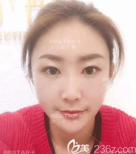 北京上上相自體脂肪面部填充案例 北京上上相自體脂肪面部填充案例