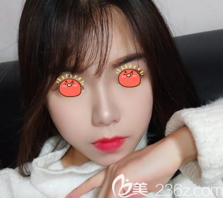 紹興維美整形醫(yī)院岳輝祛斑案例 紹興維美整形醫(yī)院岳輝祛斑案例