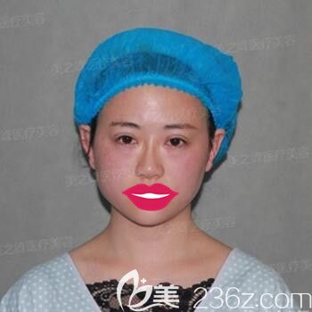 做TWO-DAYS雙眼皮術(shù)后效果