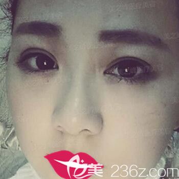 在美之峰做TWO-DAYS雙眼皮術(shù)后2個(gè)月恢復(fù)效果