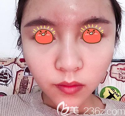 剛做完自體脂肪填充全臉的圖片