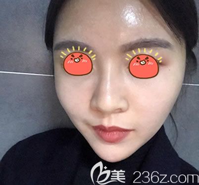 自體脂肪填充全臉15天恢復(fù)照