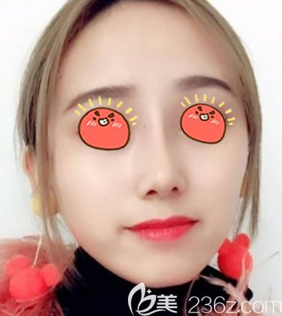 做完鼻綜合修復(fù)手術(shù)30天后 做完鼻綜合修復(fù)手術(shù)30天后