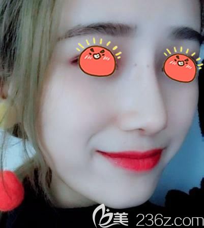 二次做隆鼻經(jīng)歷,金華瑞麗鼻綜合修復(fù)手術(shù)結(jié)束我做隆鼻失敗的噩夢!!!