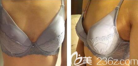 韓國(guó)芭堂整形外科醫(yī)院蓓菈假體隆胸案例 韓國(guó)芭堂整形外科醫(yī)院蓓菈假體隆胸案例