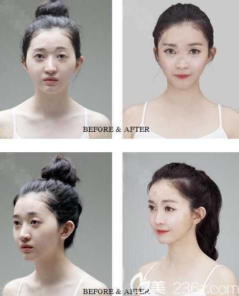 韓國德萊茵輪廓前后對比 韓國德萊茵輪廓前后對比