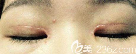 全切雙眼皮如何避免瘢痕增生